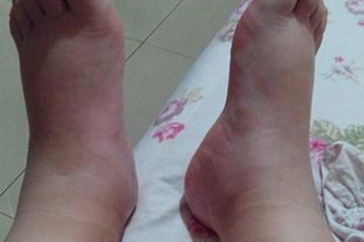 蛋白质营养不良脚部水肿发红图 蛋白质营养不良脚部水肿发红图