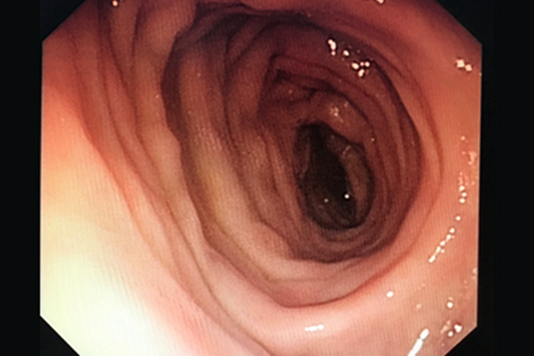 正常肠镜黏膜光整无皱壁图