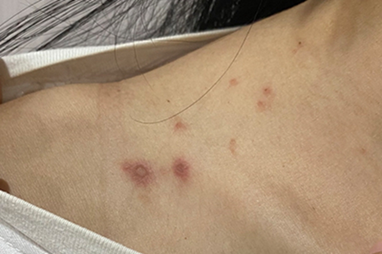 蚊虫叮咬颈部疙瘩图