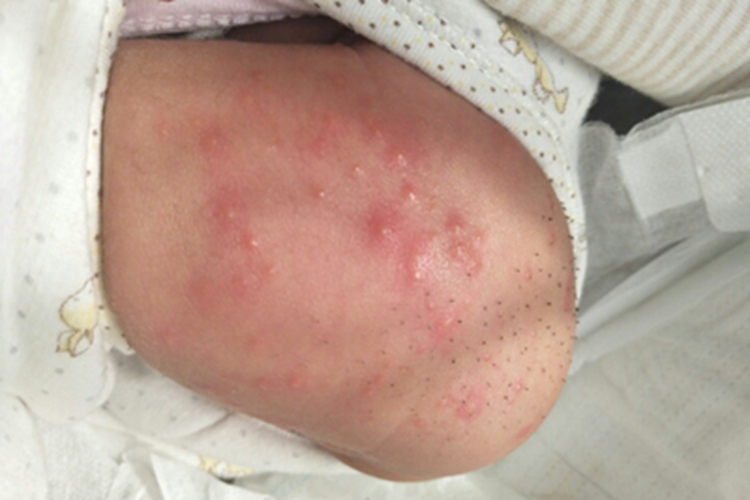 婴儿期特应性皮炎小水疱图 婴儿期特应性皮炎小水疱图