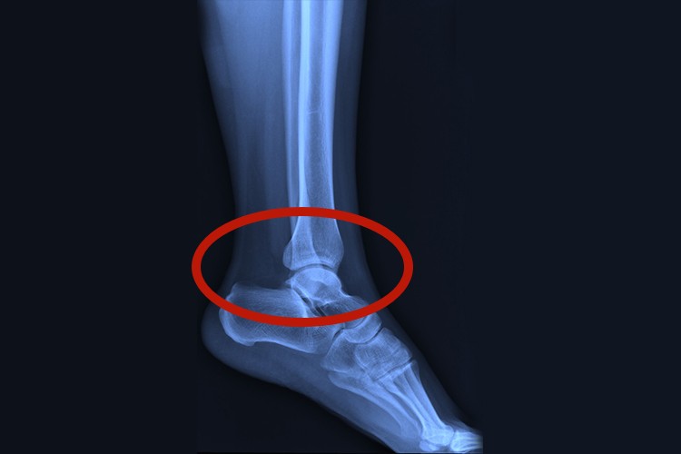 足踝部位图 足踝部位图