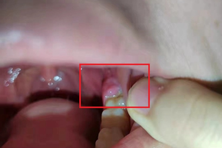 急性局限型冠周炎牙龈包块图