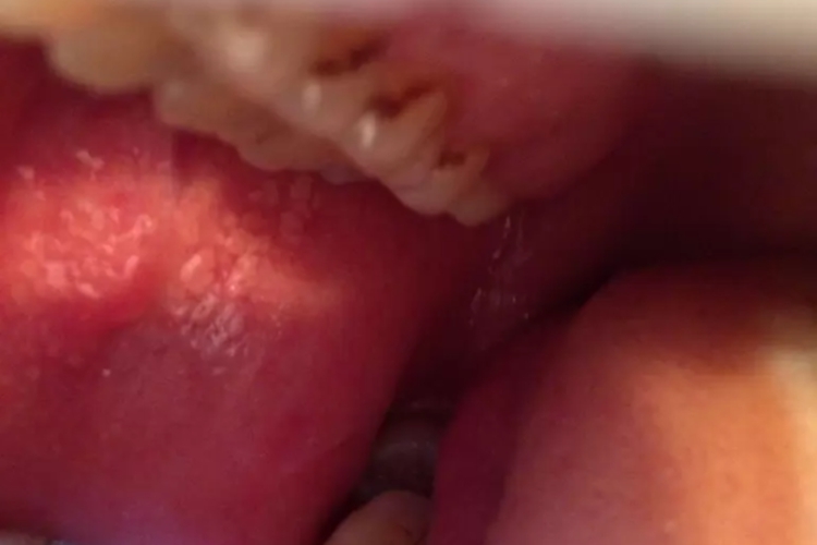 口腔迷脂症图 口腔迷脂症图