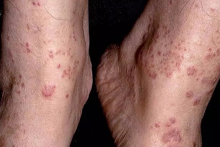 毛细血管扩张性环状紫癜症状图