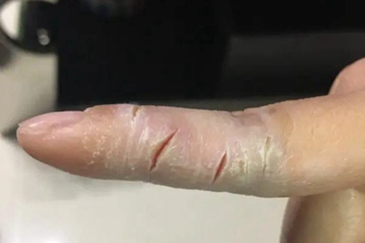 手足皲裂手指症状图
