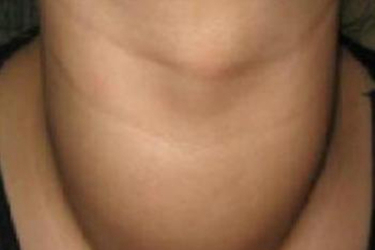 结节性甲状腺肿前颈肿块图 结节性甲状腺肿前颈肿块图