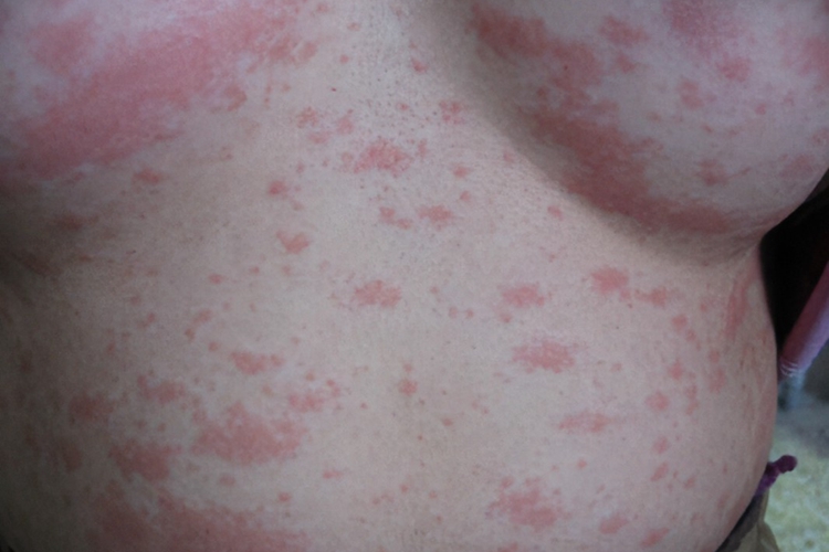 黄体酮过敏导致固定性红斑图