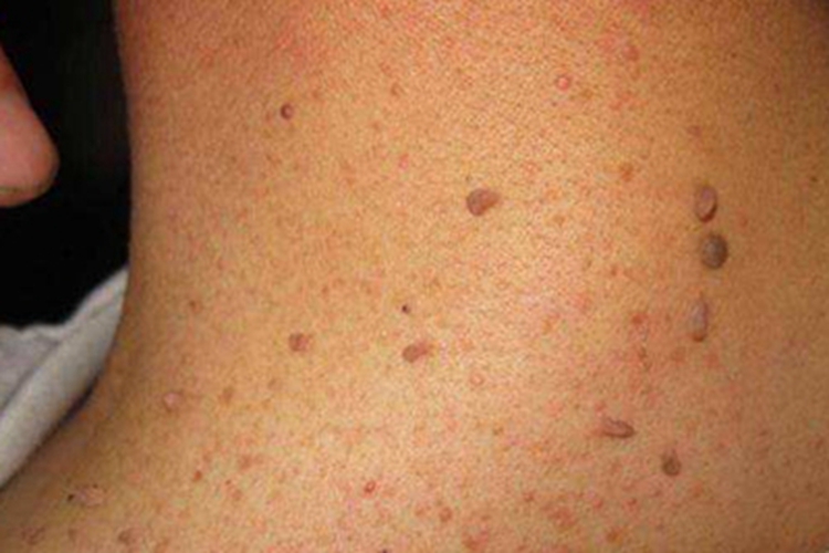 丝状软纤维瘤颈部肉赘图