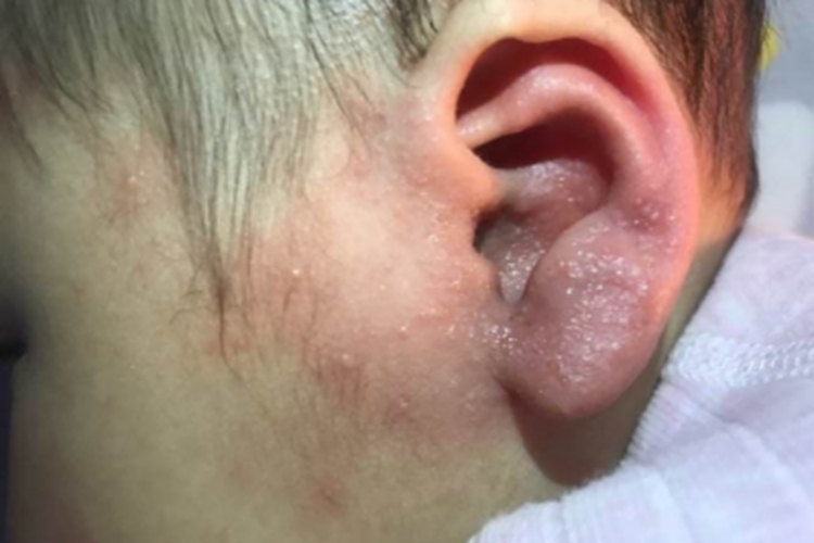 植物光皮炎耳部小水疱图