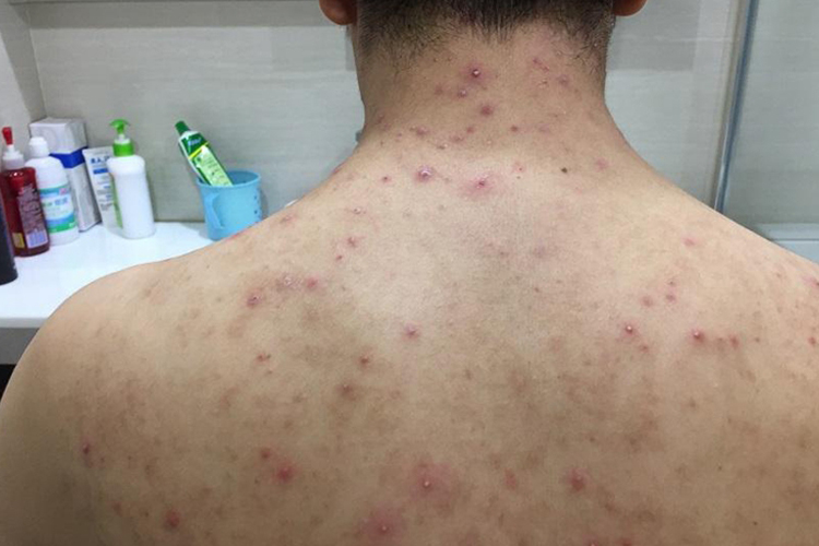 男人后背毛囊炎图