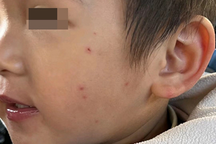 虫咬皮炎面部结痂图
