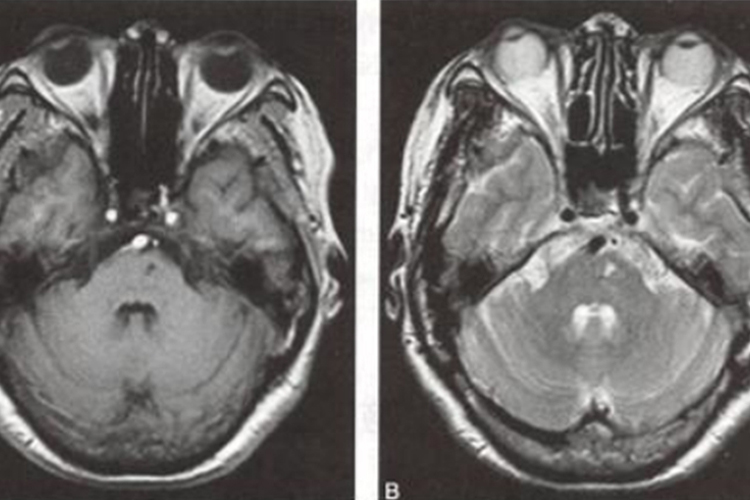 MRI的脑桥腔隙性脑卒中图