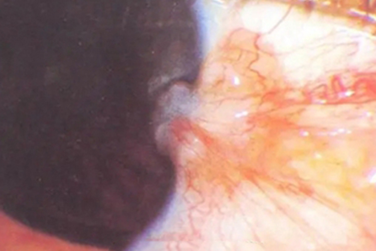 翼状胬肉结膜红斑图 翼状胬肉结膜红斑图