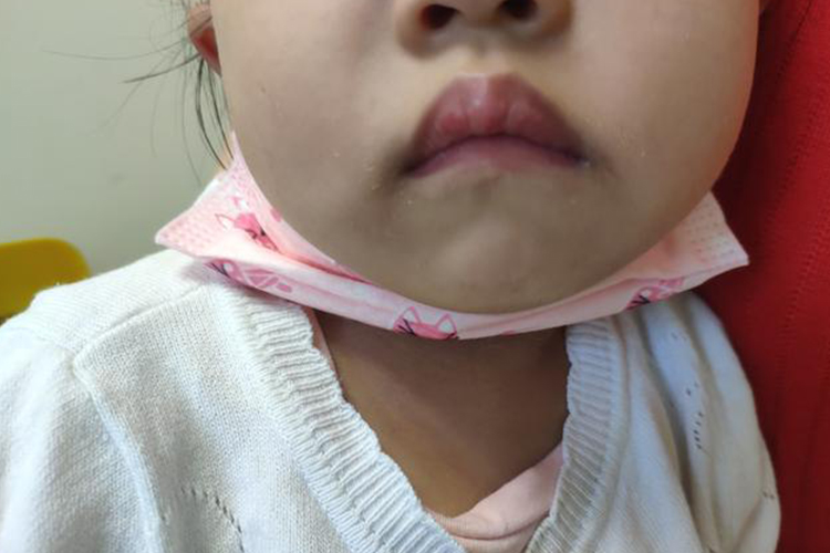 4岁儿童腺样体面容图