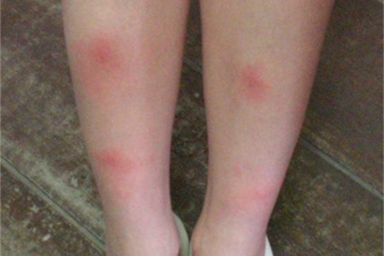 硬结性红斑小腿有红斑图