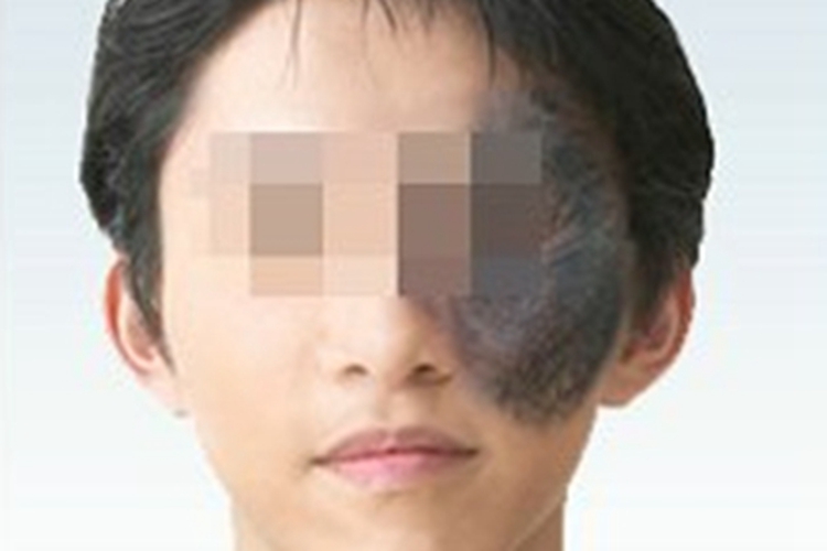 太田痣左侧脸上有黑斑图