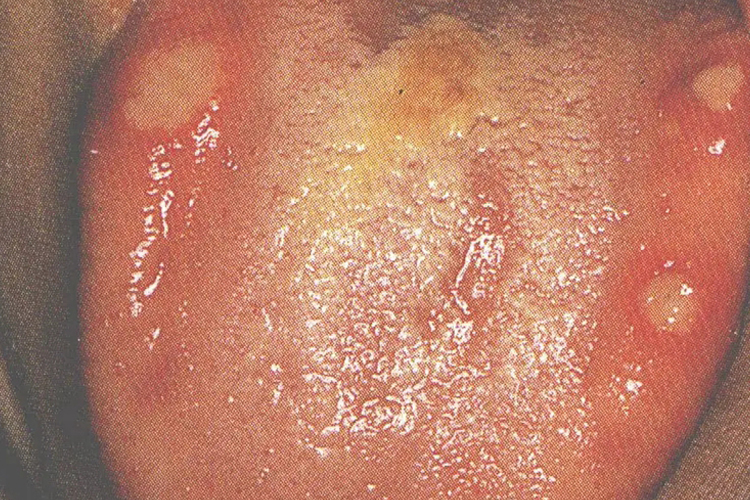 舌头原发性疱疹性口炎图 舌头原发性疱疹性口炎图