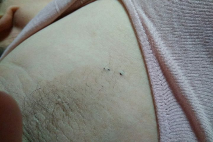 腋窝皮肤黑头粉刺