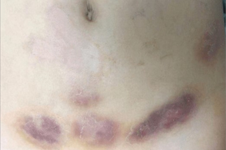 偶遇分枝杆菌感染腹部紫斑图 偶遇分枝杆菌感染腹部紫斑图