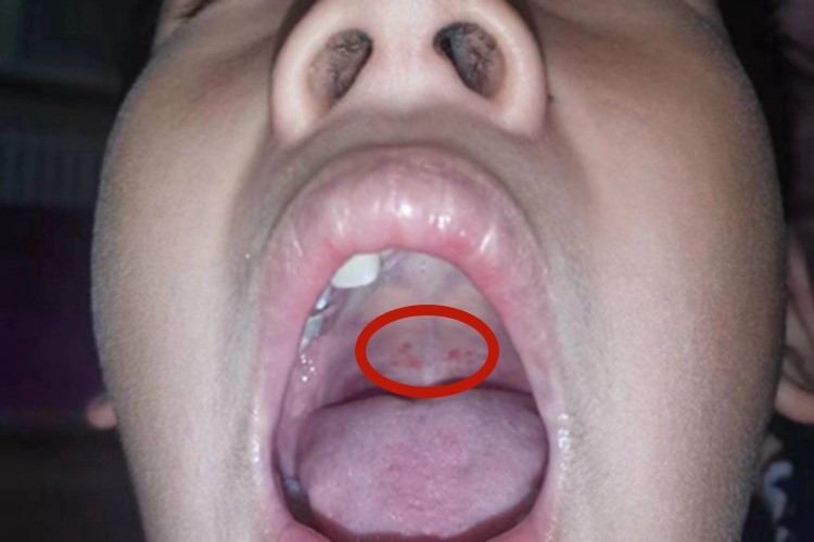 疱疹性口炎上颚有水疱图