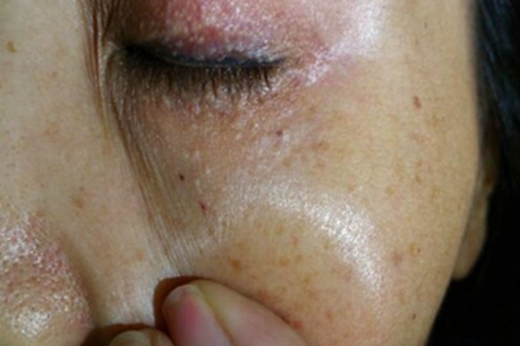 汗腺瘤眼皮针尖大小丘疹图