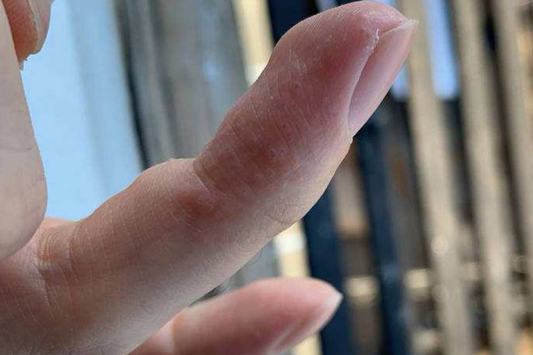 汗疱疹手指黏膜受损图