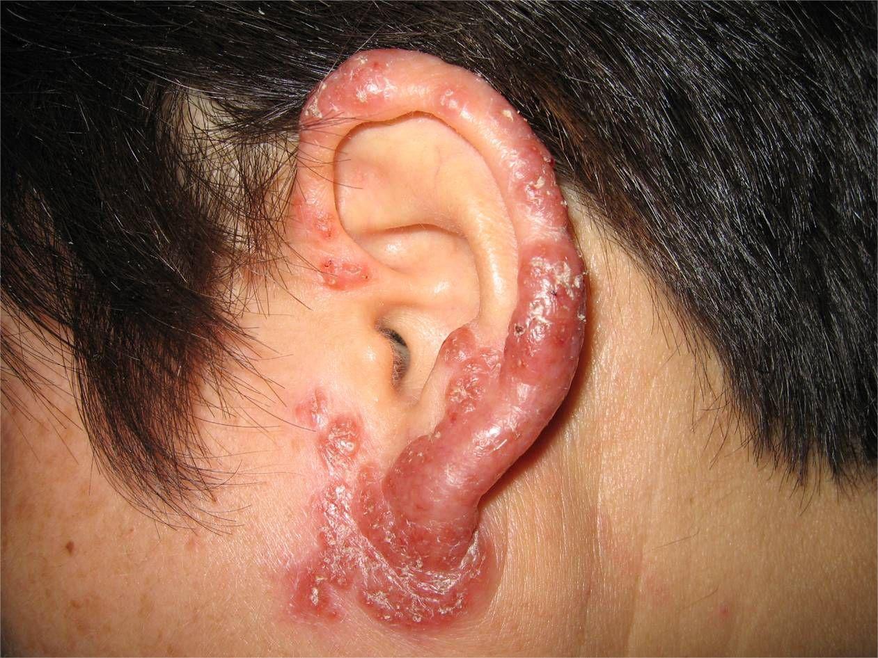可表现为患者耳朵上出现暗红色水肿性丘疹,丘疱疹,表面覆有痂皮,自觉