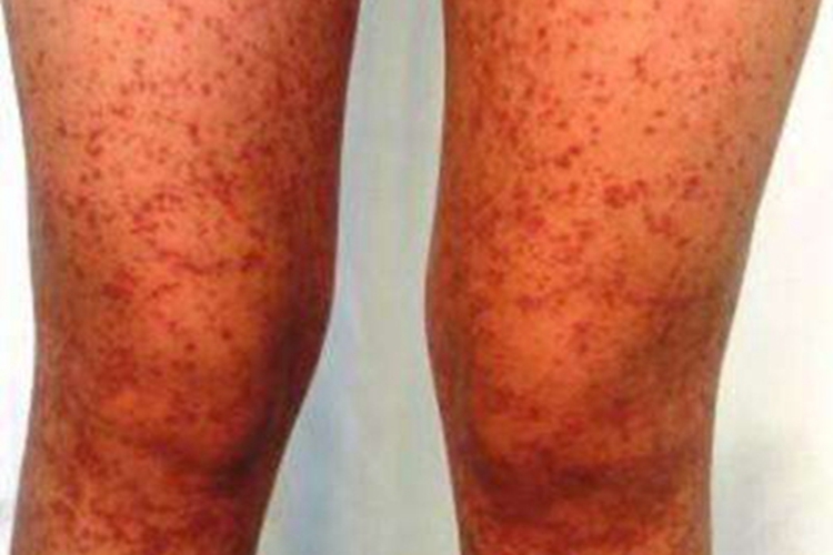 过敏性紫癜腿部有密集红斑图