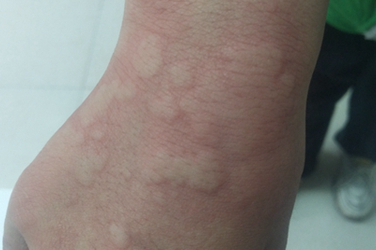 急性自发性荨麻疹手腕小疙瘩图 急性自发性荨麻疹手腕小疙瘩图