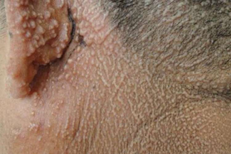结节型黏液水肿性苔藓症状图