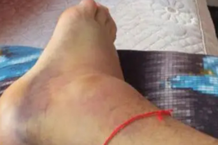 踝扭伤脚踝肿呈紫色图 踝扭伤脚踝肿呈紫色图