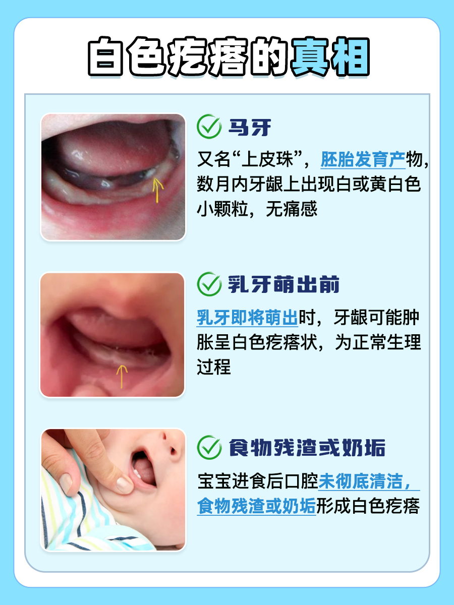 宝宝牙龈上的白色疙瘩藏何秘密