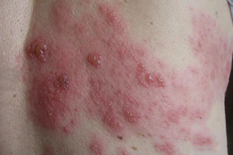 单纯型大疱性表皮松解症水疱图