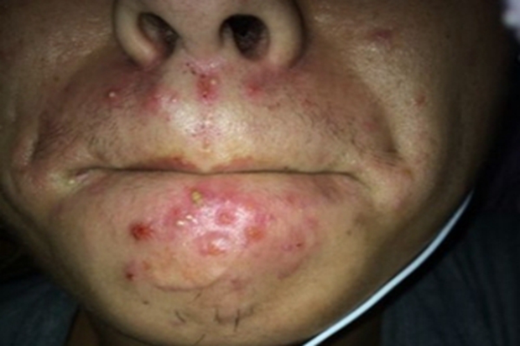 类脂质蛋白沉积症口周症状图 类脂质蛋白沉积症口周症状图