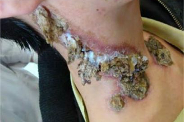 慢性黏膜皮肤念珠菌病颈部化脓图 慢性黏膜皮肤念珠菌病颈部化脓图