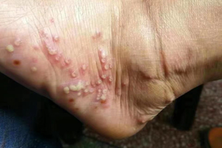 脓疱病脚部脓包图