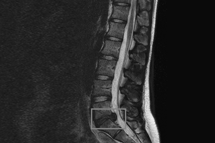 腰椎间盘突出影像图 腰椎间盘突出影像图