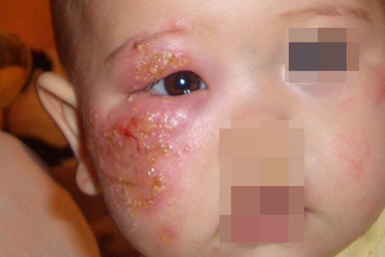 新生儿脓疱疮面部黄痂图