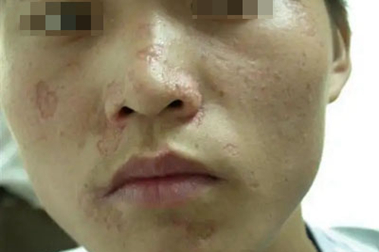 进行性特发性皮肤萎缩面部斑图