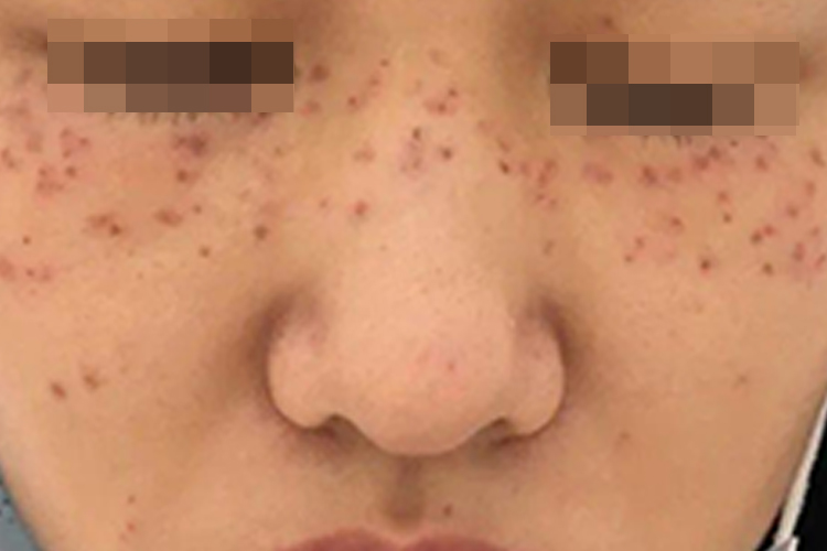 皮秒祛斑后3-5天图