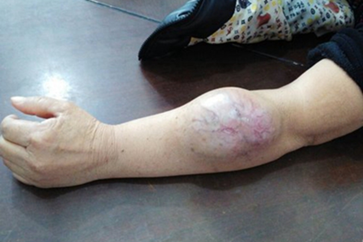 纤维肉瘤胳膊大包图 纤维肉瘤胳膊大包图