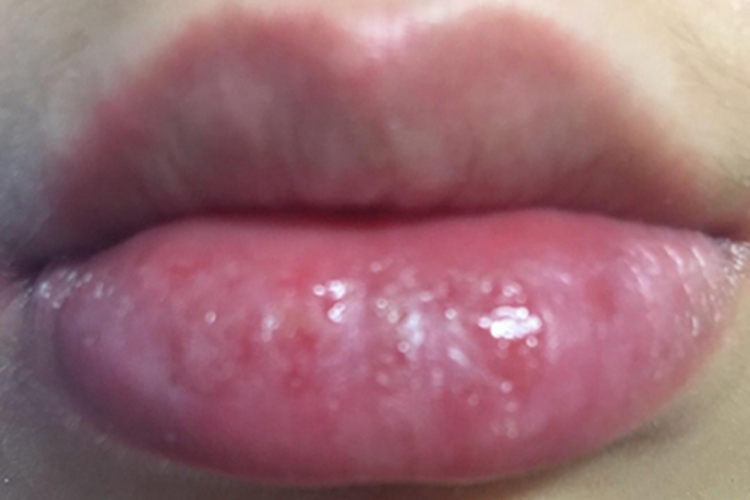 接触性唇炎嘴唇肿胀图 接触性唇炎嘴唇肿胀图