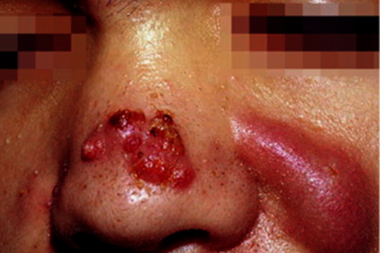 寻常痤疮面部囊肿结痂图