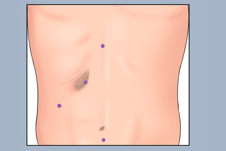 胆囊手术打孔位置图