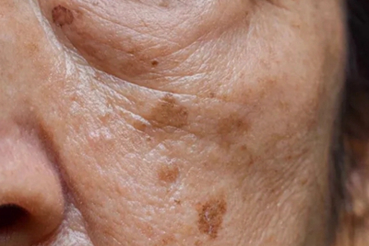 光老化长斑图 光老化长斑图