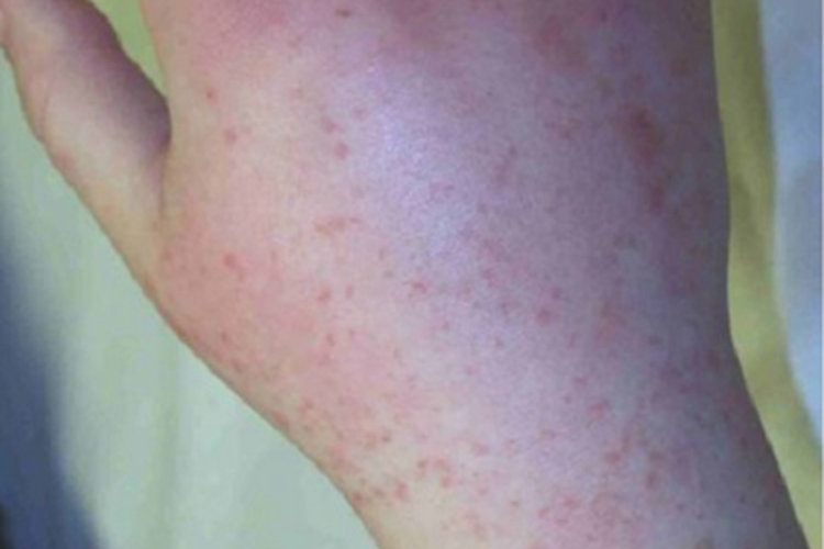 先天性风疹综合征手背症状图 先天性风疹综合征手背症状图