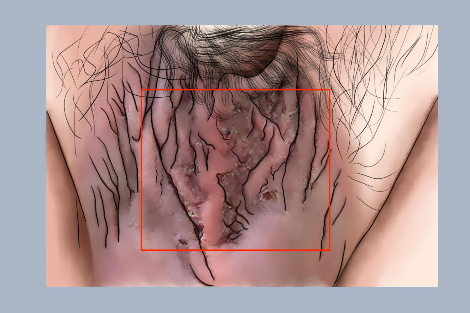 男性阴囊湿疹图