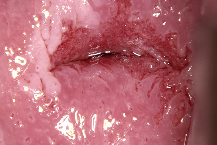 宫颈锥切恢复三个月后图 宫颈锥切恢复三个月后图