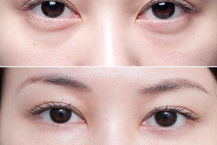 有眼袋和无眼袋对比图 有眼袋和无眼袋对比图