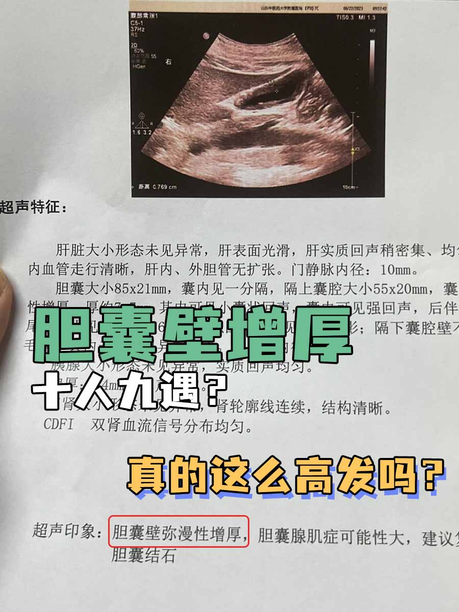胆囊壁增厚，十人九遇？真的这么高发吗？